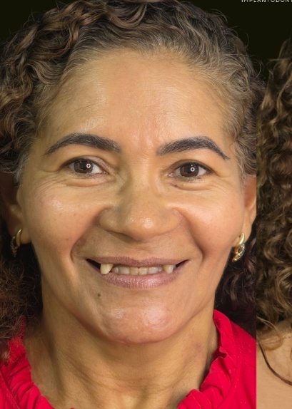 Antes do Implante Dentário - Dr. Lucas Lopes